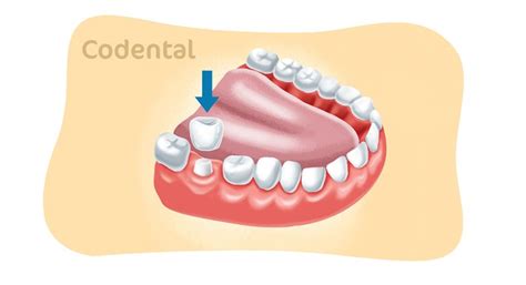 Coroa dentária: 6 principais tipos que você precisa conhecer!